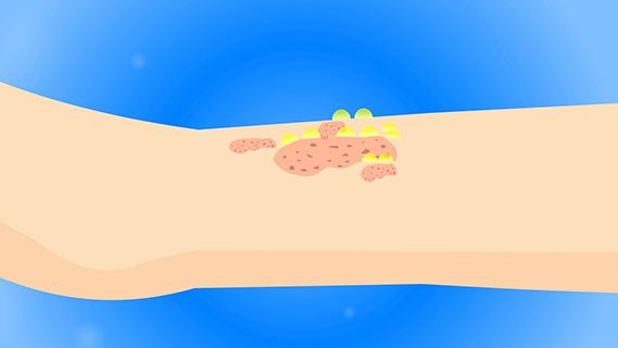 热毒疮与湿毒疮的图片(危险的皮肤病) - 赤虎壹号