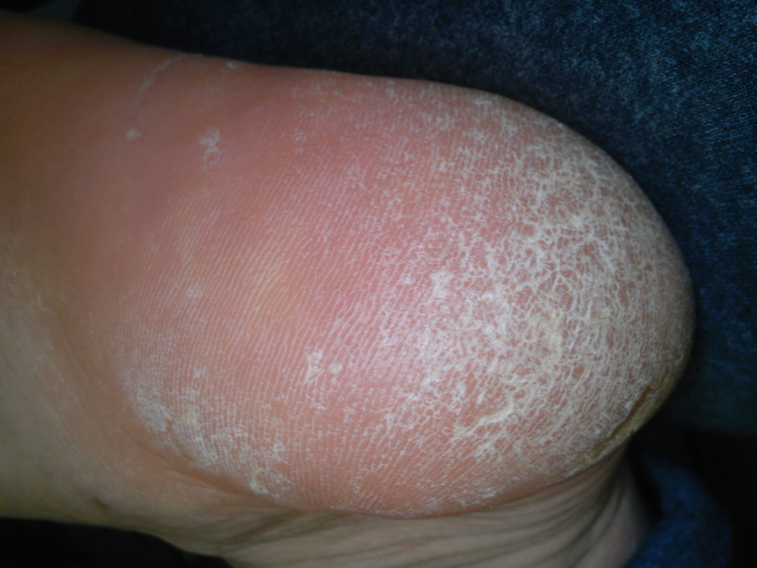 脚底脱皮是怎么回事 脚底脱皮用什么药-千百号