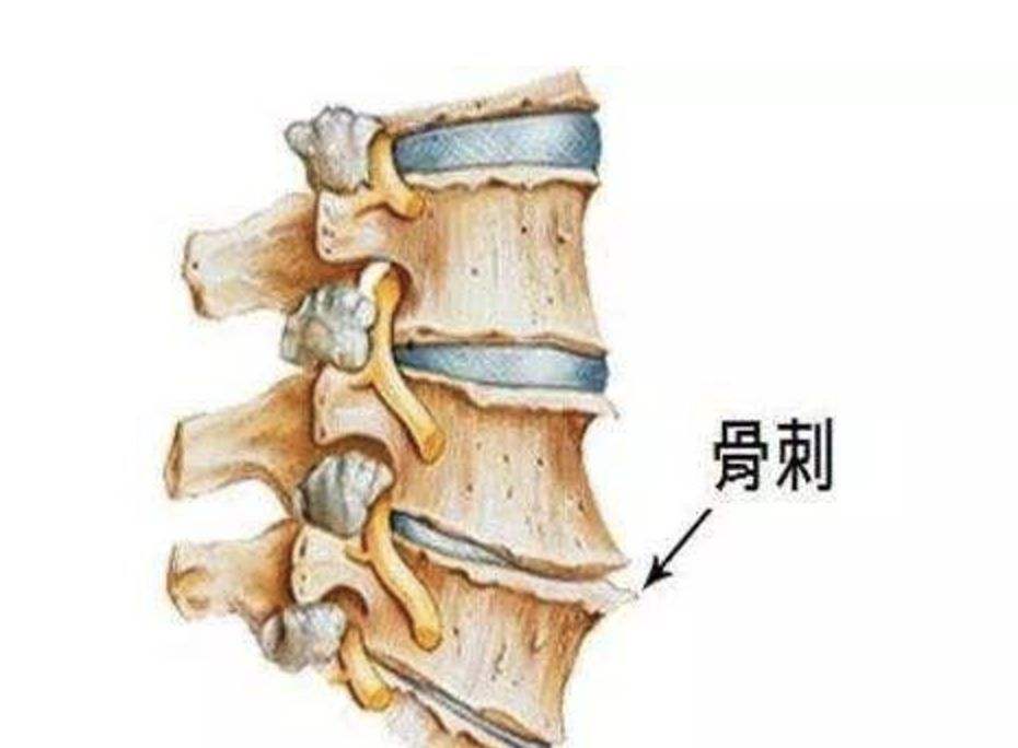 刘翔骨刺是怎样(辟谣：骨刺和骨质增生不一样，不去医院贴膏药就能治好？)