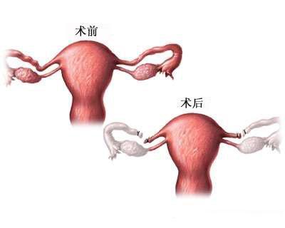 你结扎了吗？妇科医生：关于女性结扎的这些事你真懂？