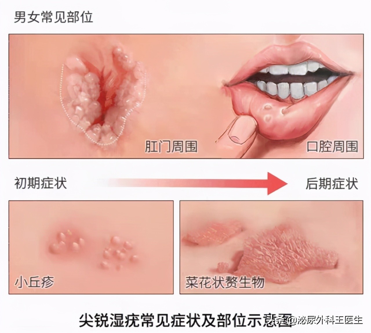 肛门摸到了小肉球，是痔疮还是尖锐湿疣？医生来教你区分