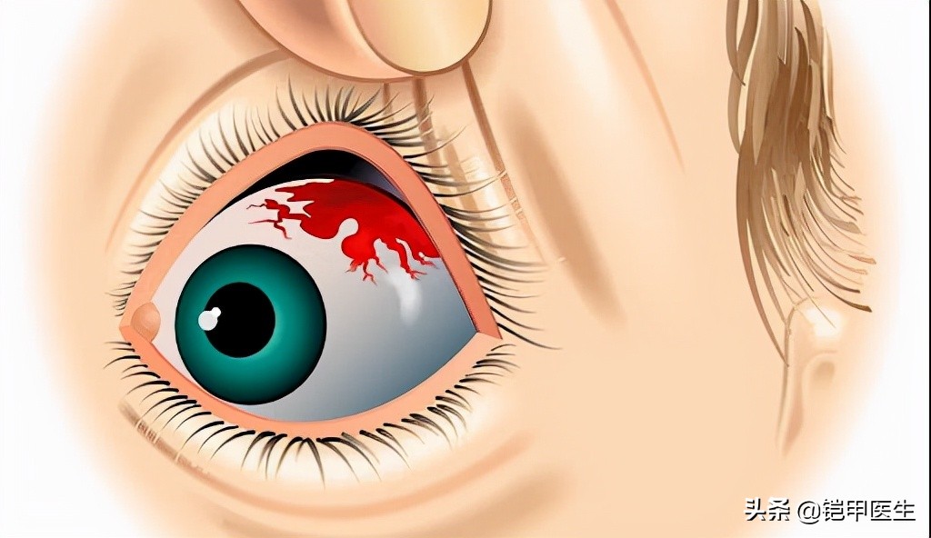 眼底出血的12种原因(眼睛出血是怎么回事?
