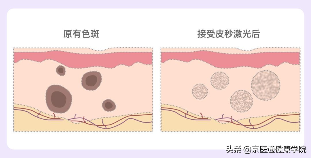 皮秒拿走的是「斑点」，还是你的不自信？