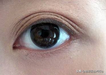 外眼角下垂能否通过双眼皮手术调整？多重眼皮能否手术调整？