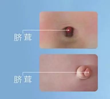 网传:宝宝出生四周肚脐发炎去世,新生儿肚脐护理刻不容缓!