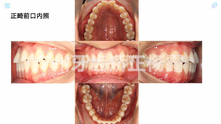 广州牙齿矫正杨露隐适美隐形矫正戴牙套全案例