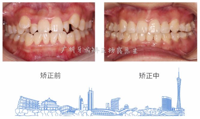 广州牙齿矫正杨露隐适美隐形矫正戴牙套全案例