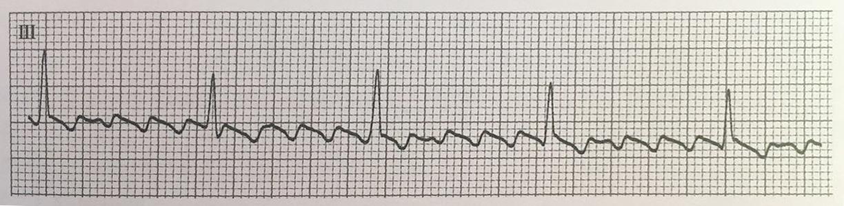 检查心脏，心电图、心脏彩超哪个更准确？看看医生怎么说