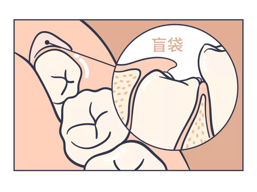 智齿被盲袋覆盖图片(未来医生) - 赤虎壹号