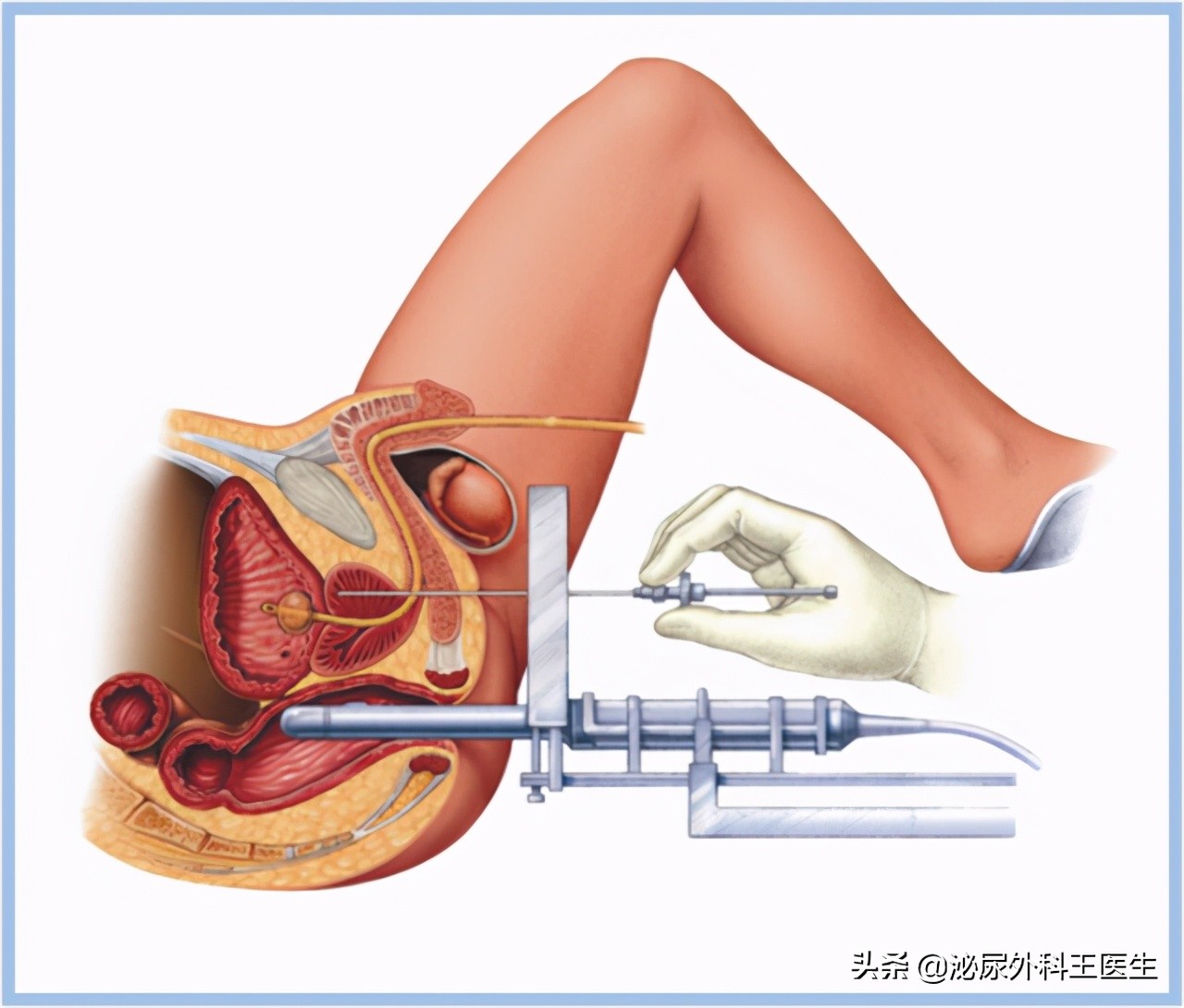 前列腺增生的原因 前列腺增生怎么办-蟋蟀号