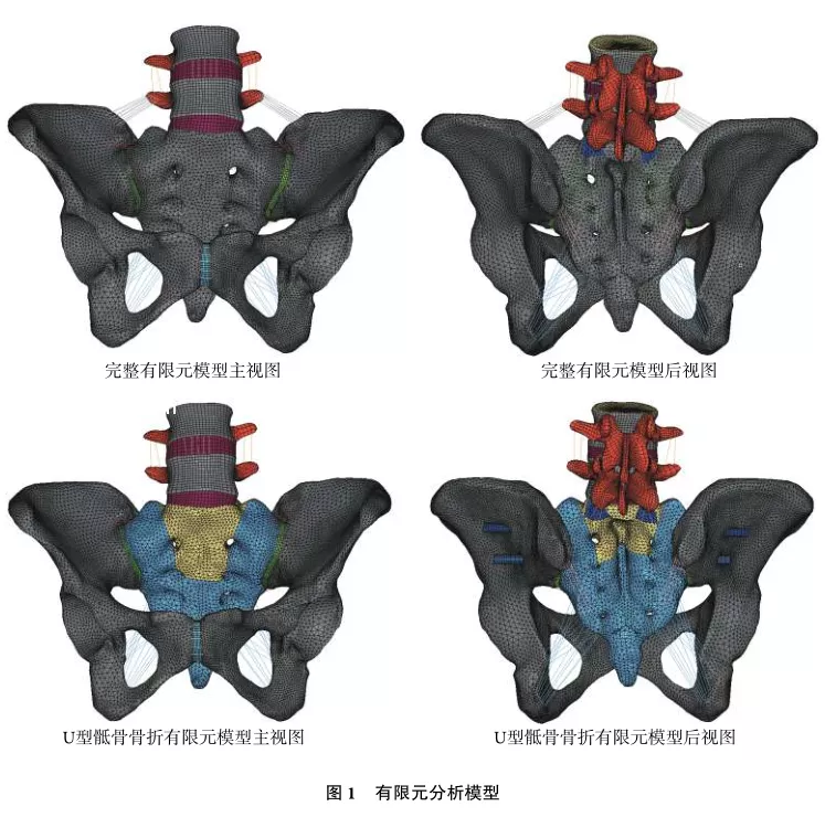 U型骶骨骨折固定的有限元分析