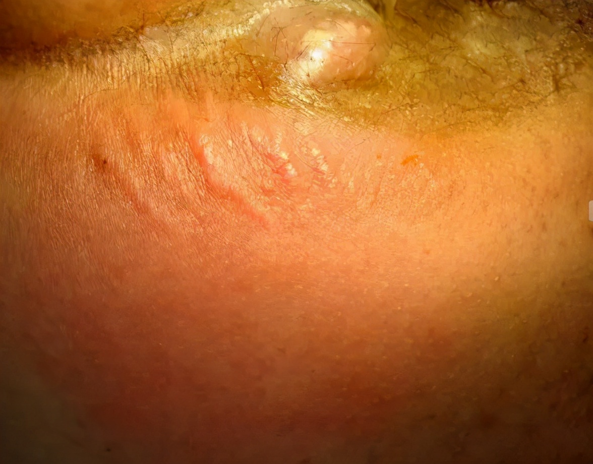 患者问:我注意到,国内关于这病总共有三个名称,肛瘘,肛漏,肛周脓肿,您