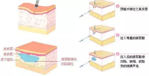 脸上长皱纹？不要怕！它可能是“假”的