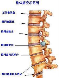 腰椎疾病、腰椎间盘突出你想知道的事全集！