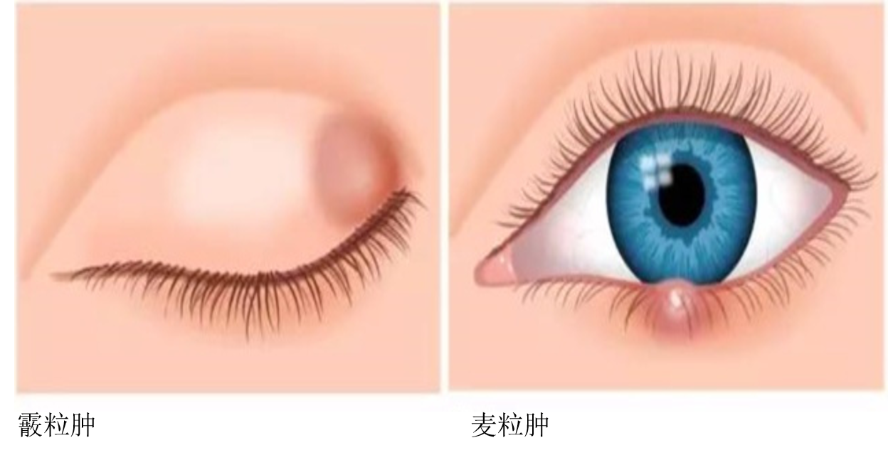 霰粒肿和麦粒肿的区别图片「霰粒肿和麦粒肿的区别及手术原则」-友友