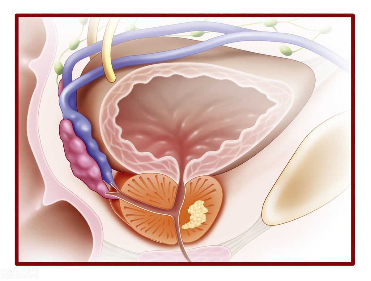 前列腺癌有什么症状？如何预防前列腺癌？