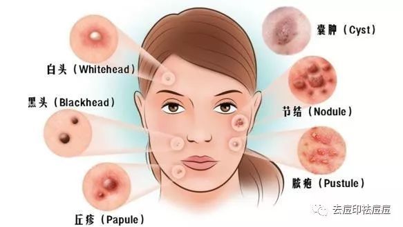 闭合性粉刺治疗方法大揭秘：有效去除顽固痘痘的护肤指南