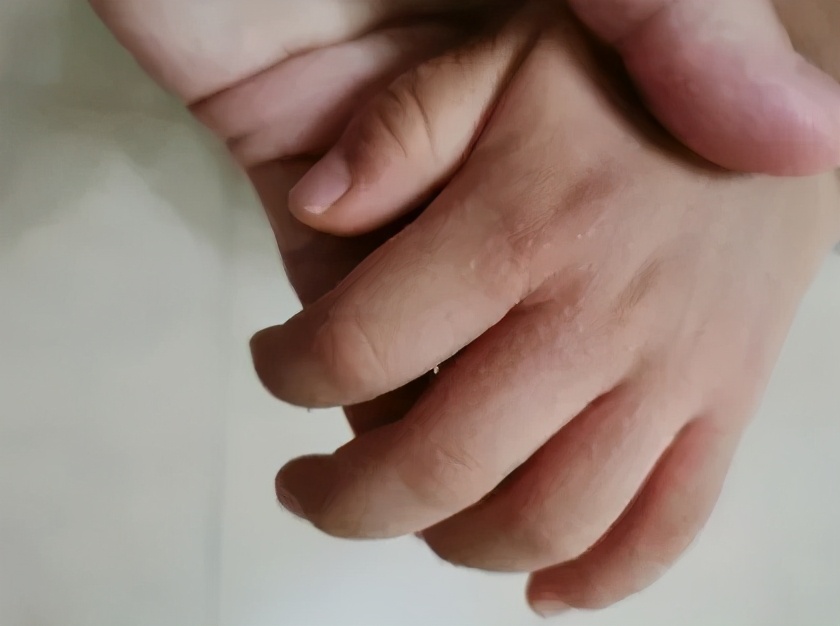 孩子手上起很痒的小疙瘩，是什么？怎么办？