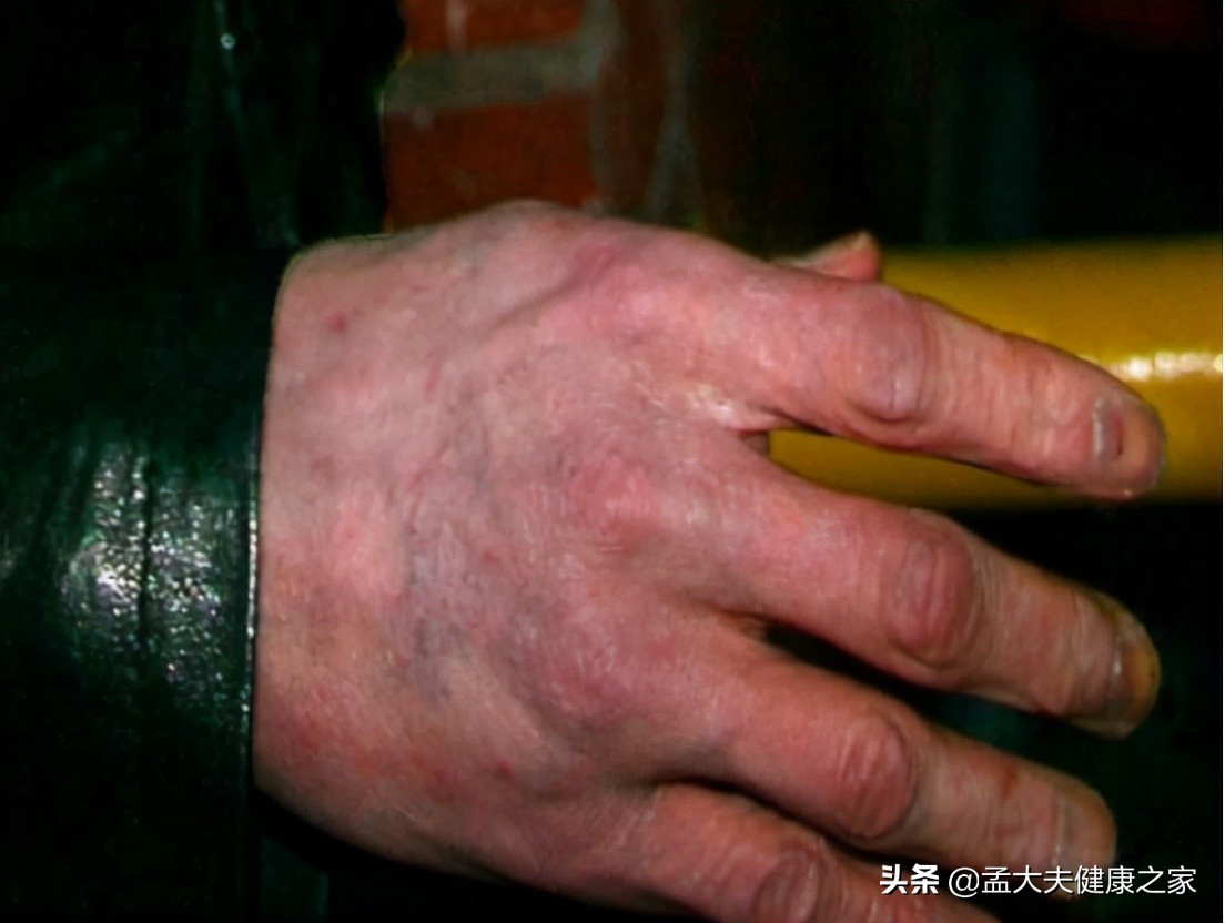 得了灰指甲怎么治？2个治疗方法效果好，安全不复发