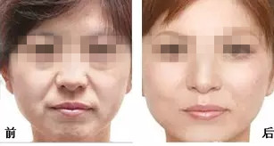 常见的面部抗衰项目有六种，能去皱美肤，恢复你的年轻貌美