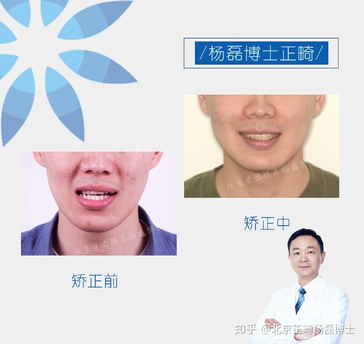 北京正畸杨磊博士：骨性反颌偏颌患者