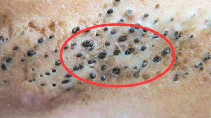 几招教你秒去螨虫