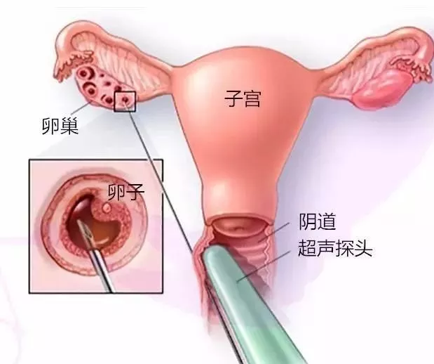 取卵真的特别疼吗？