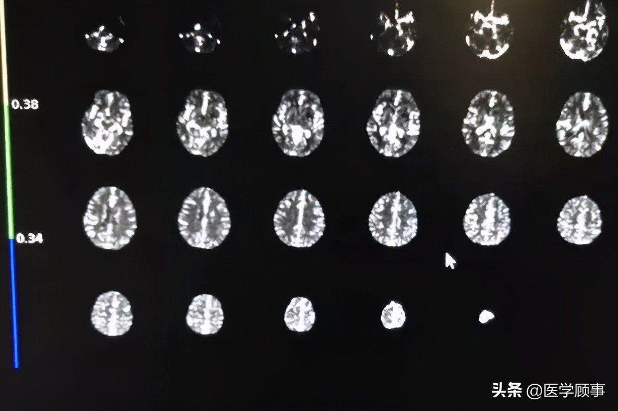 血管内取栓治疗超时间窗的左侧大脑中动脉闭塞