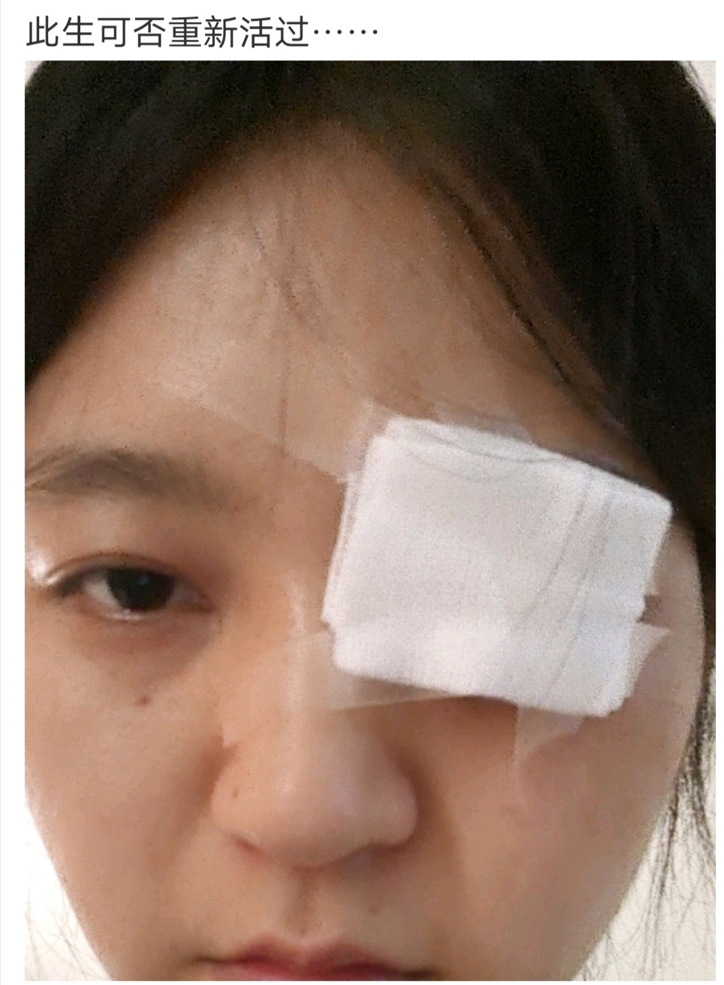 敷麻药灼伤图片对比照(被热油烫后) - 赤虎壹号