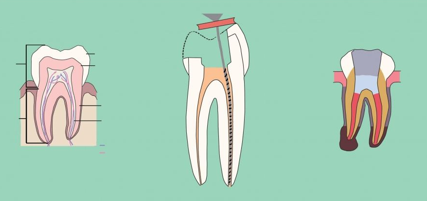 为什么做牙齿修复的时候，要给牙齿打桩？牙医告诉你到底有什么用