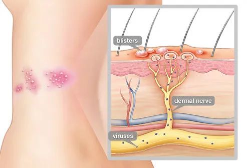 进口国产药剂量差5倍？百万带状疱疹患者被当性病来治