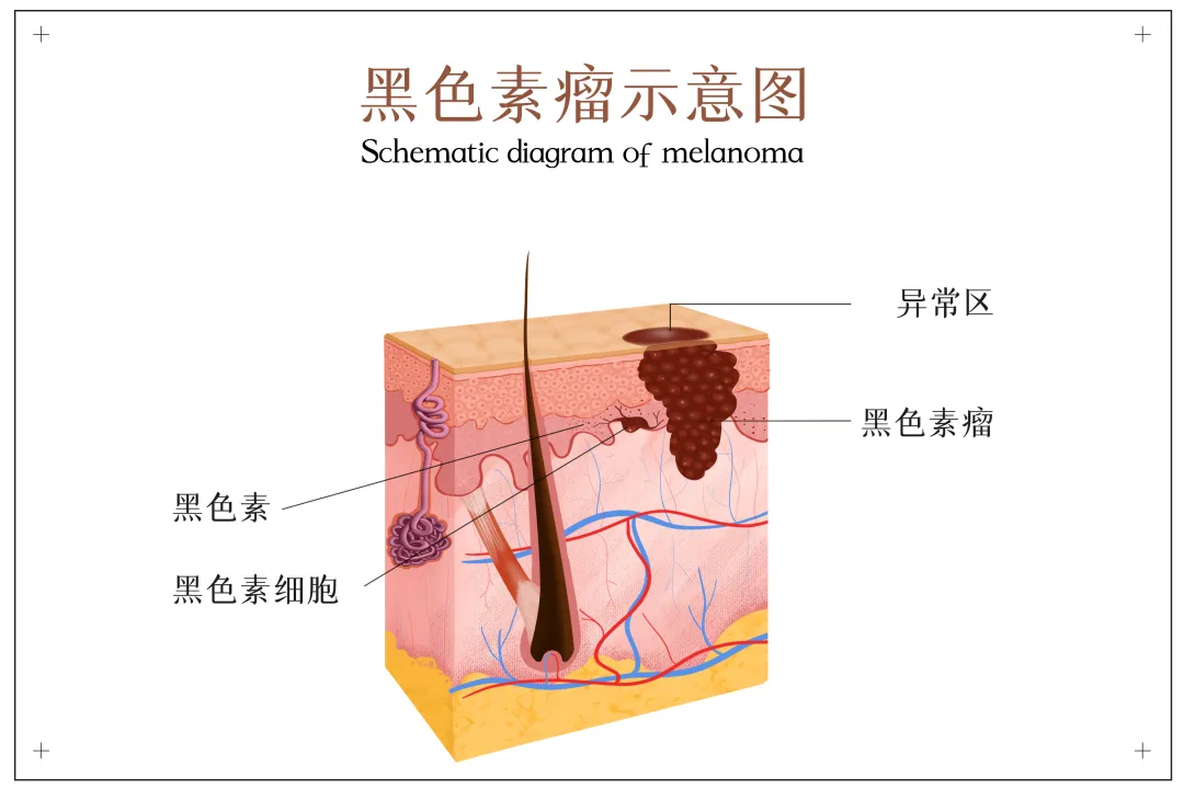 第一期｜中国科学院大学附属肿瘤医院（浙江省肿瘤医院）：恶性黑色素瘤规范诊疗看“浙”里