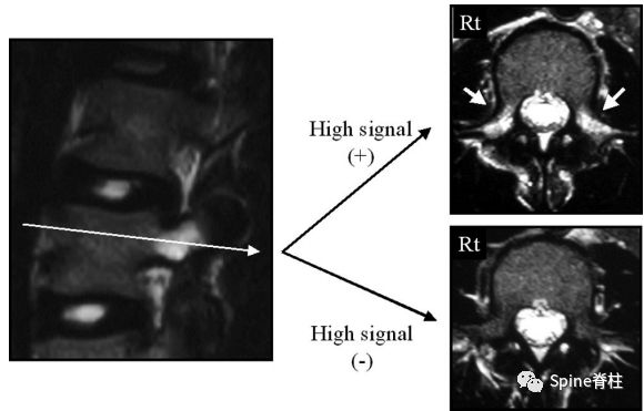 从诊断到治疗：全面解析腰椎峡部裂(lumbar spondylolysis)