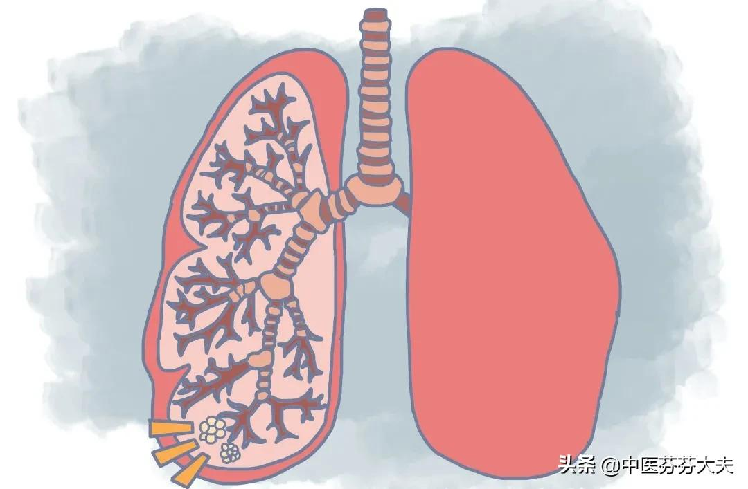 体检发现肺小结节怎么办？不要慌，听听医生怎么说