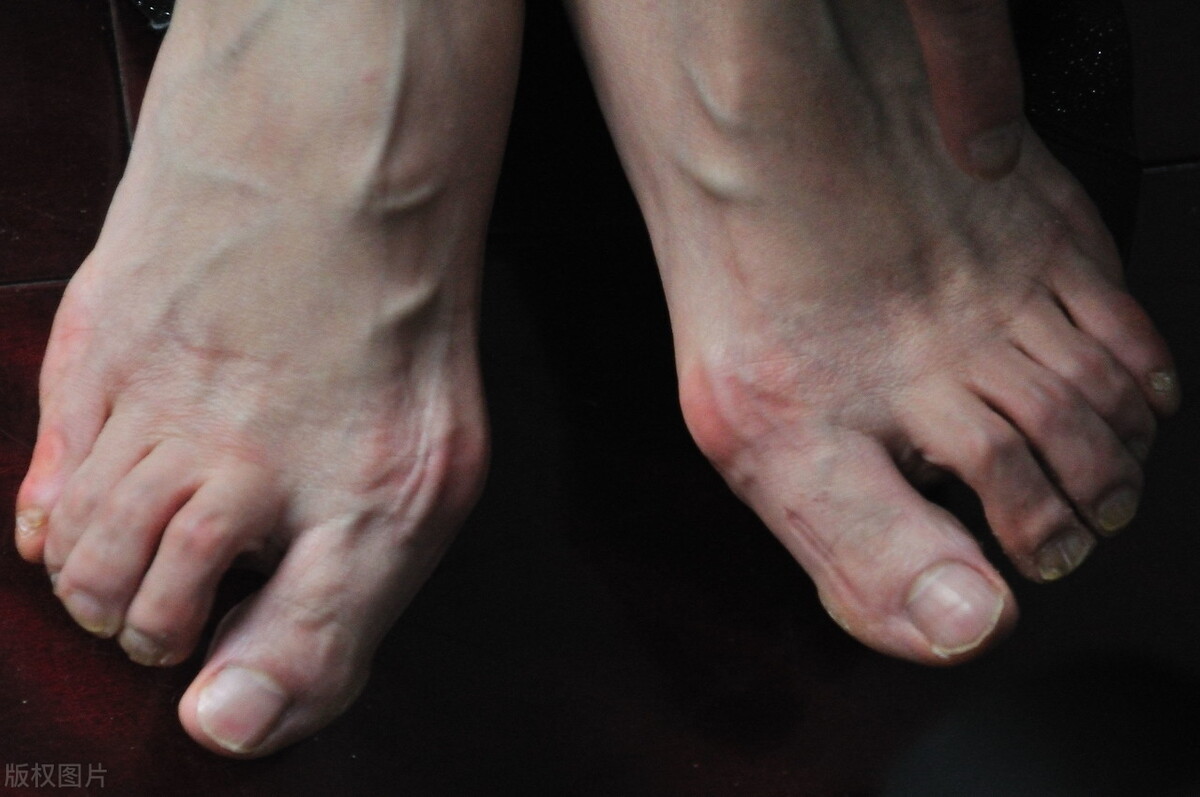 原作者:北京市长虹律师事务所陈键锋律师10级工伤,粉碎性脚趾骨折