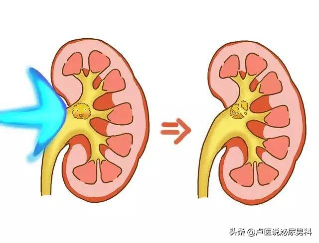 如果你患有尿路结石，准备通过“体外冲击波碎石”治疗，请看此文