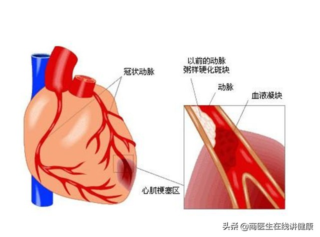 降压新药：沙库巴曲缬沙坦，特别适合国人，强效控压同时保护心肾