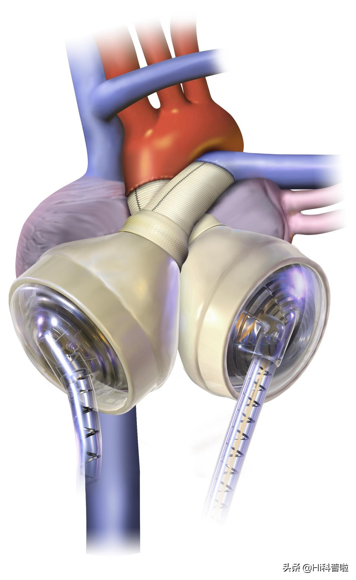 我国再造黑科技！全磁悬浮人工心脏研发成功，心衰患者重燃希望