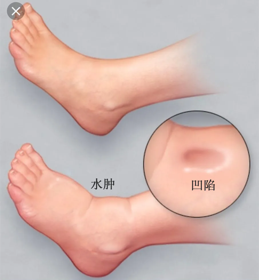 不同部位的「肿」暗示了什么?一组“水肿位置图”搞清楚
