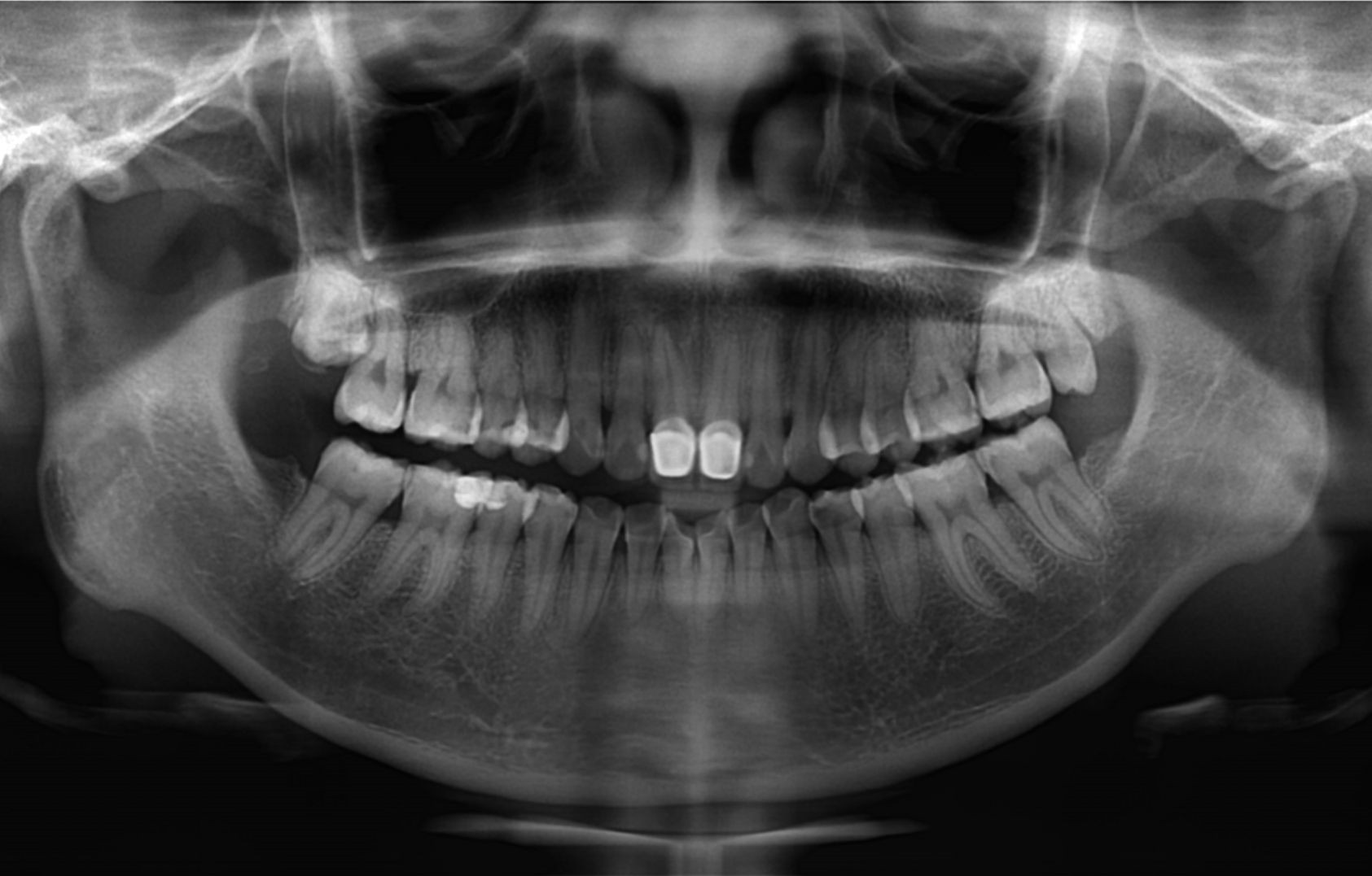 正常牙齿侧面图x光片图片