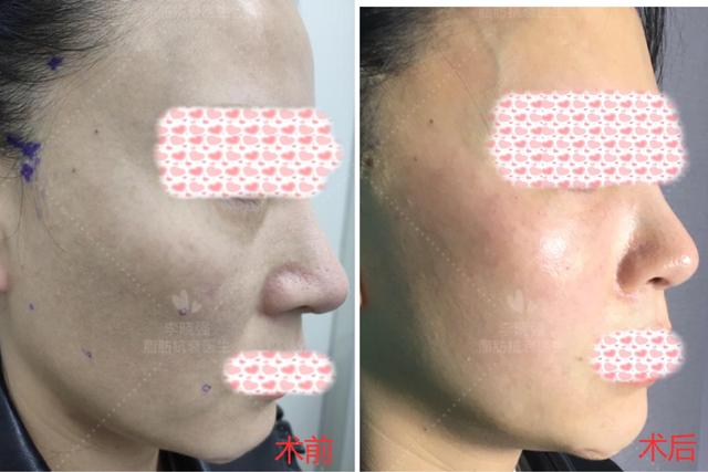 女生遇上面部凹陷，不仅是显老的问题！整形医生教你怎么正确应对