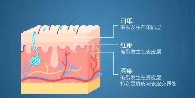 宝宝热出一身痱子，婆婆竟然说不准吹空调！婴儿热痱该如何护理？