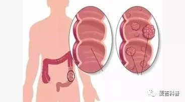 拉出大便带血怎么办？怎么处理，什么原因导致的？