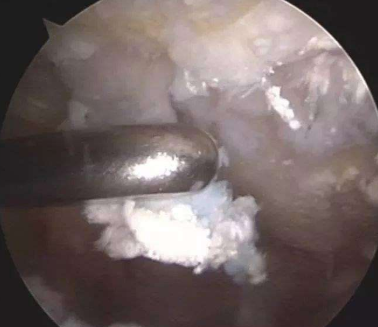 医生从我体内取出一盆石头，都是痛风惹的祸！痛风石怎么治疗？