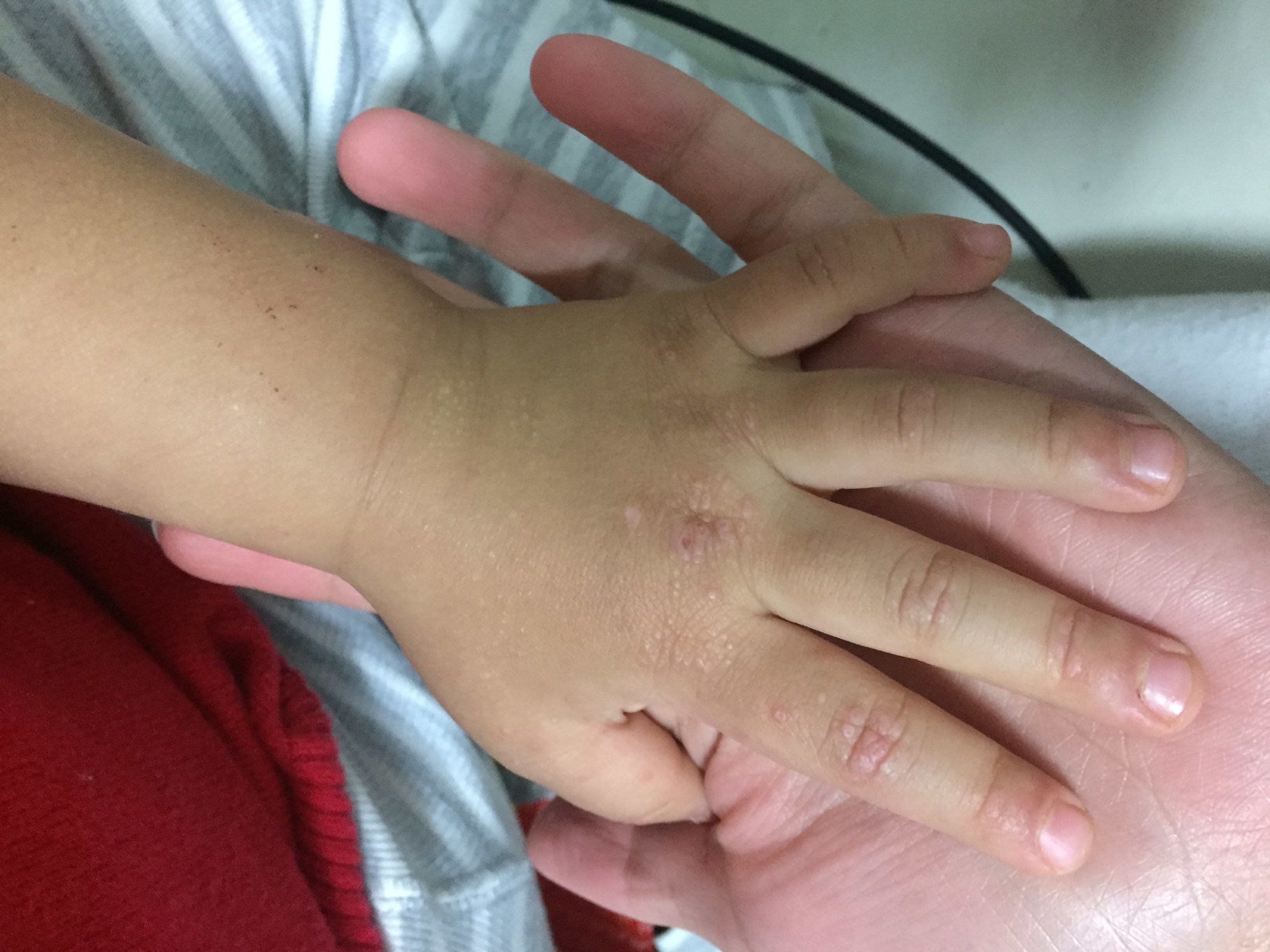 夏天到来,小朋友的皮肤出现小丘疹,这是什么病?