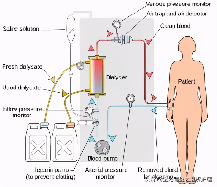 1 血透机正式推向市场动静脉shunt的发明,自体动静脉内瘘成形术的成功