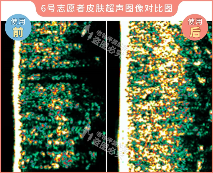网红家用美容仪真的有效吗？2个多月的跟踪实测结果来了