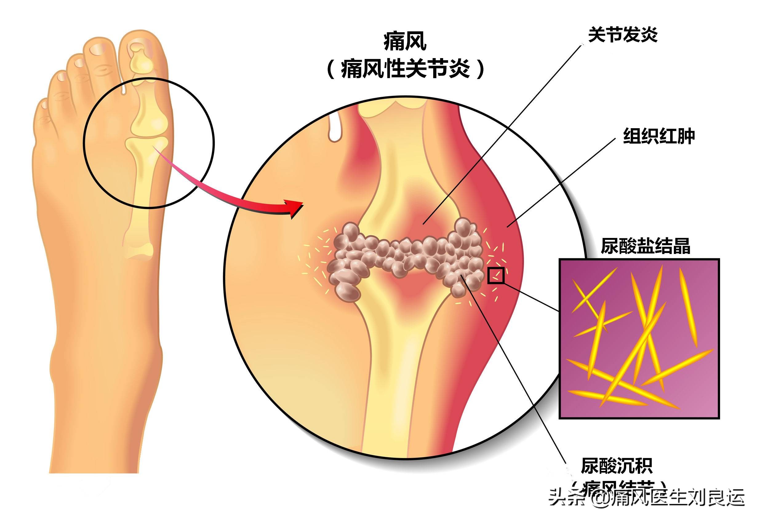 痛风急性发作只会在大脚趾上？不，手脚等四肢关节都可能发作