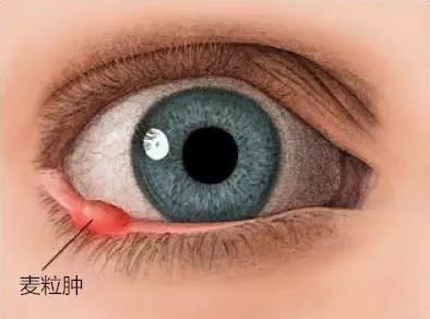 偷针眼图片(眼睛长东西) - 赤虎壹号