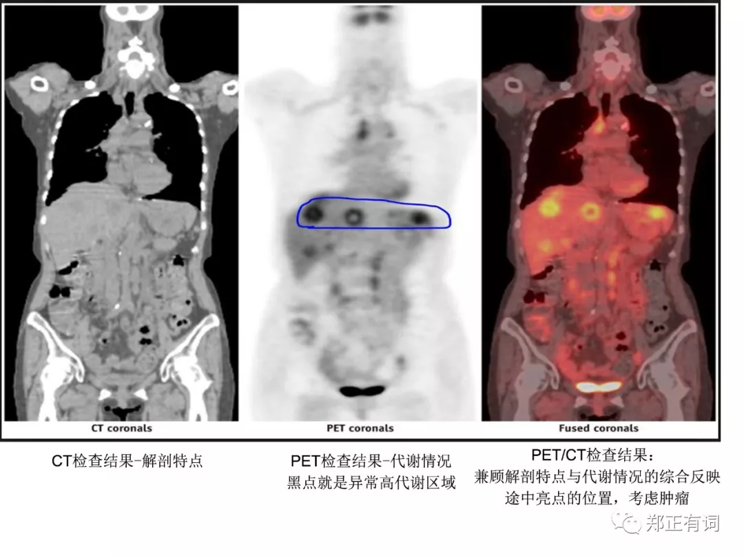 针对恶性肿瘤的最尖端、最先进、最准确的影像学评估手段—PET/CT，做一次9000块？还不报销！